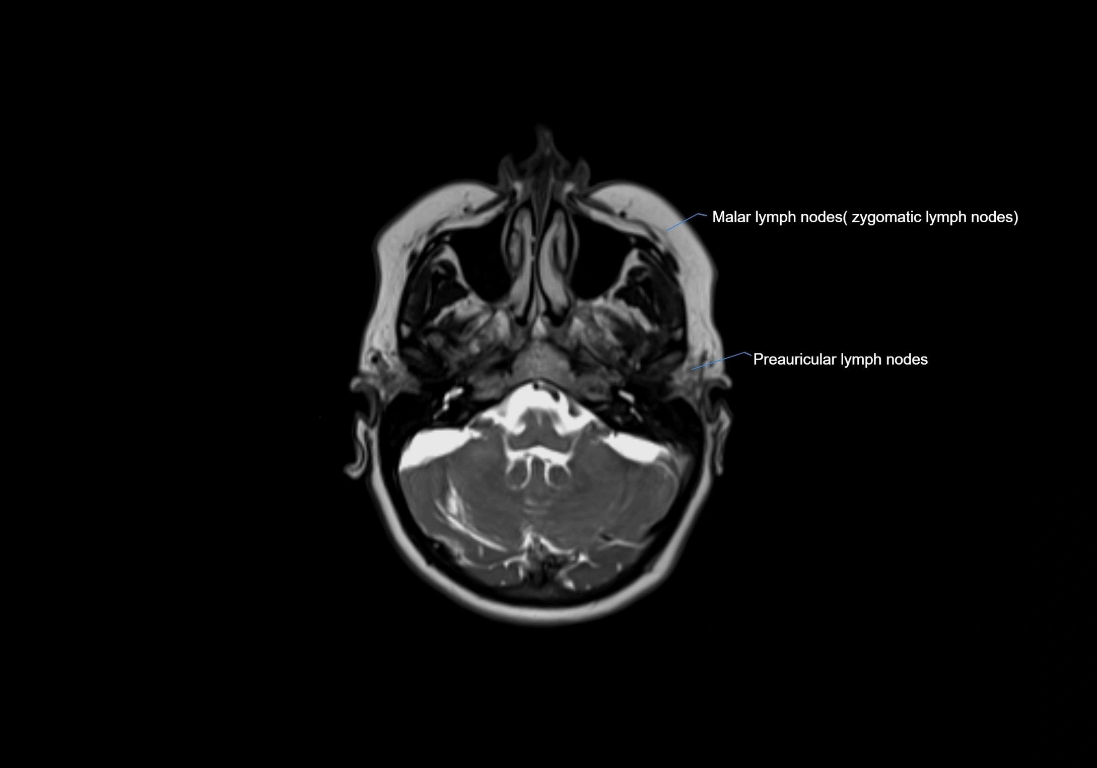 Neck axial  lymph node cross sectional MRI anatomy 3T MRI  image-img-00001-00017.webp